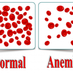 What Is Anemia