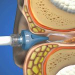 ear washing drugmed.ir